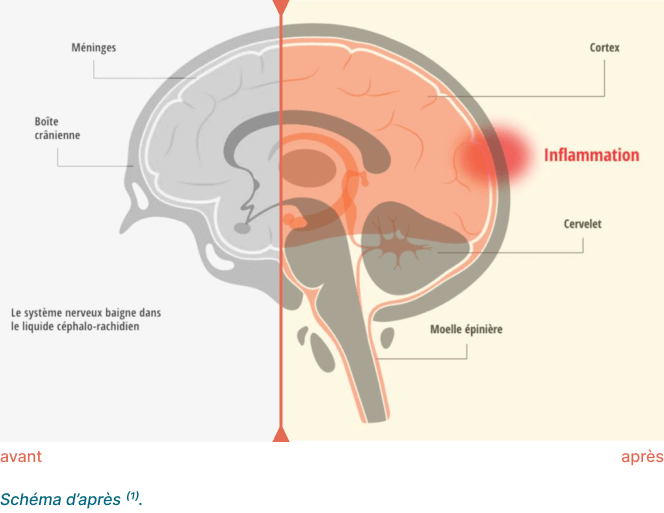 Schéma illustrant les méninges, le cerveau et l'inflammation dans le cerveau, indiquant différentes parties comme le cortex, le cervelet, et la moelle épinière.