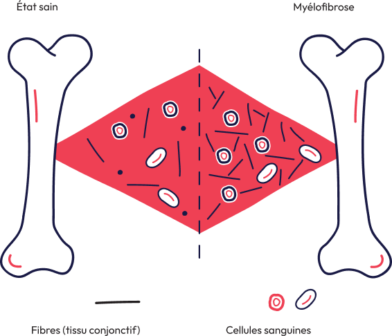 illustration comparative entre des cellules sanguines saines et des cellules sanguines atteintes de myélofibrose