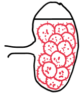 illustration d'un ganglion infesté de lymphomes