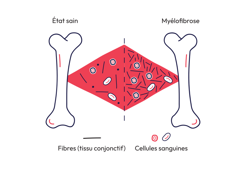 myelo bones
