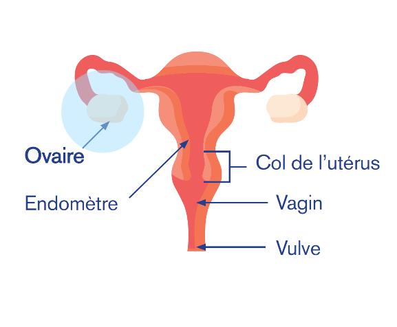 Signes précurseurs du cancer de l’ovaire